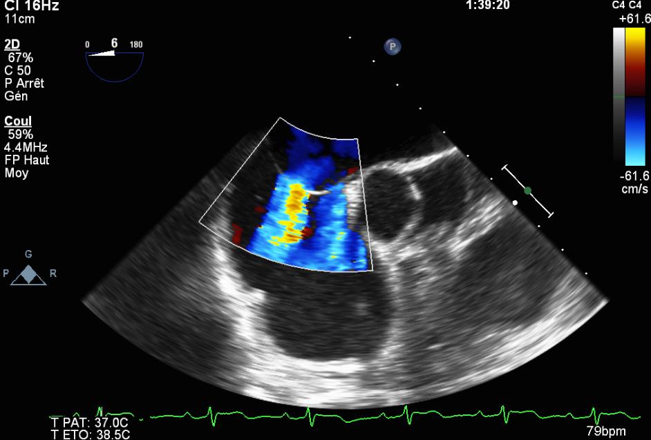 Image 1. Transoesophageal echocardiography of ASD and PFO LA LA RA AOV RA AOV RV RV Transoesophageal echocardiography as used in this study for the initial diagnosis of atrial septum pathologies.