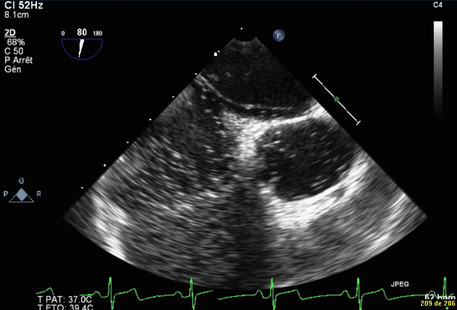 Left, view in a patient with an atrial septal defect, showing spontaneous passage of blood from the left to the right atrium at rest with Doppler through the atrial tissue defect (arrow).