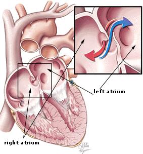 Definition PFO is an incomplete closure of the atrial septum that results in the creation of a flap or a valve- like opening in the atrial septal wall.