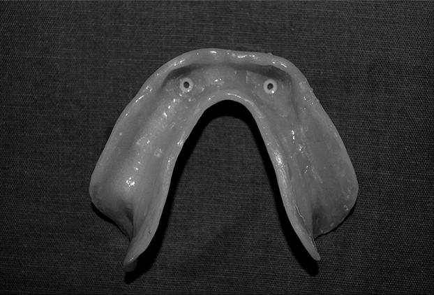 The diameter of the custom ball attachment was similar with that of diameter of orthodontic separators. The casting was done in a conventional manner.