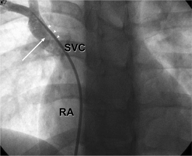 PAPVC and pulmonary hypertension 961 Table 3 Comparison of the haemodynamic variables observed during right heart catheterization in group I and group II partial anomalous pulmonary venous return