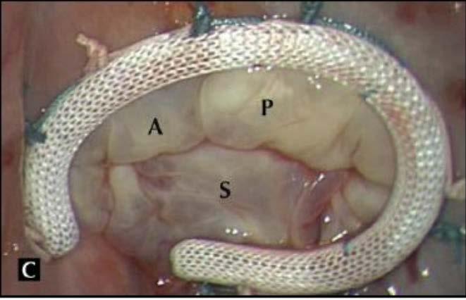 Tricuspid annuloplasty