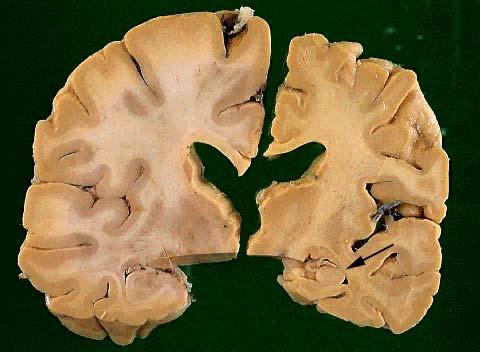 Normal brain half on the left and an abnormal half on the right.