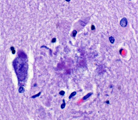 Alzheimer s Disease: Micropathology High-power views of neuritic plaques.