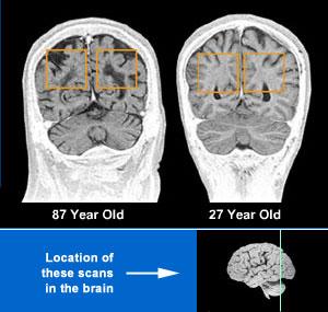Brain Aging: Normal Basal Ganglia Subarachnoid Space White Matter The basal ganglia are clusters of nerve cells responsible for initiatiting and integrating movements.
