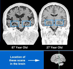 Brain Aging: Normal The hippocampus is the memory center of the brain.