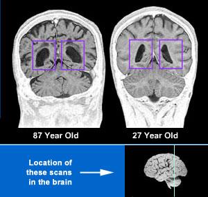 significant memory loss. The ventricles are hollow spaces filled with cerebrospinal fluid.
