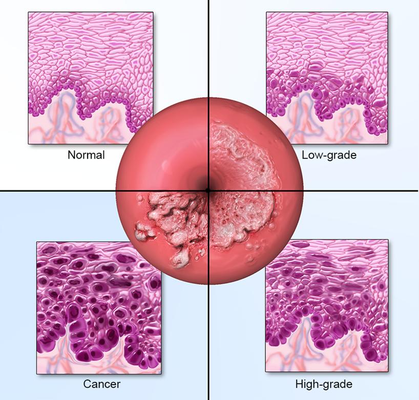 Progression to cervical cancer Normal cells of the cervix gradually develop precancerous changes that can eventually