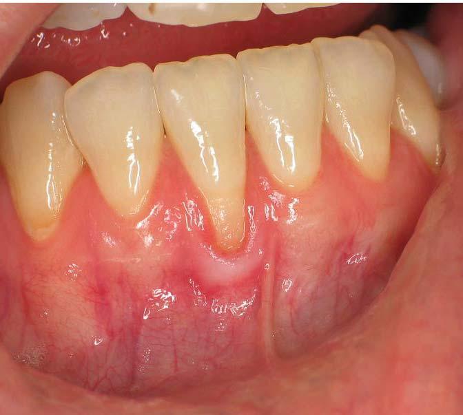 The Use of DynaMatrix Extracellular Membrane for Gingival Augmentation: A Case Series Dr.