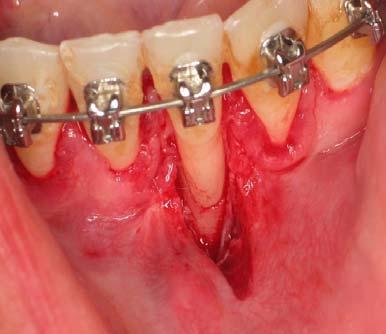 Patient presented with severe recession in teeth #24 and # 25 due to bone loss from