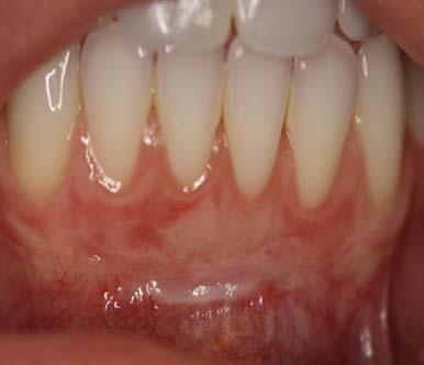 Case 7: Thicken Gingiva and Develop Keratinized Tissue. Patient presented with thin zone of attached gingival tissue.