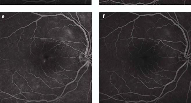 retinal layers (a). OCT 8 weeks after intravitreal injection of triamcinolone acetonide showing significant resolution of macular edema (b).