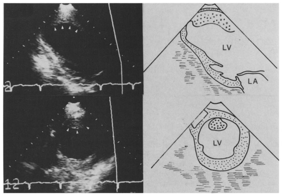 904 NIHOYANNOPOULOS ET AL. VENTRICULAR THROMBUS IN MYOCARDIAL INFARCTION JACC Vol. 14, No. 4 October 1989903-I I Figure 1.