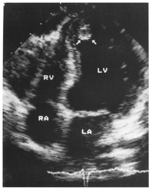 906 NIHOYANNOPOULOS ET AL. VENTRICULAR THROMBUS IN MYOCARDIAL INFARCTION JACC Vol. 14, No. 4 October 1989:903-11 Figure 3.