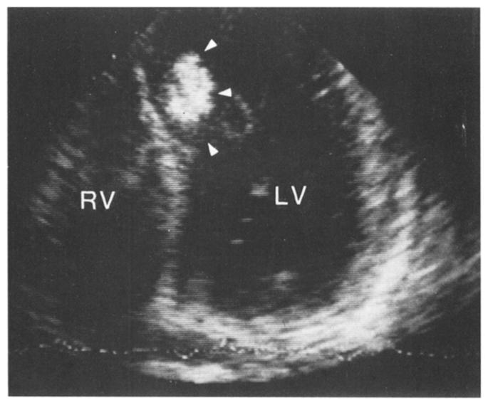 echoes within the distal left ventricular cavity (Fig. 5). In the remaining 32 patients with anterior infarction, as well as in Figure 4.