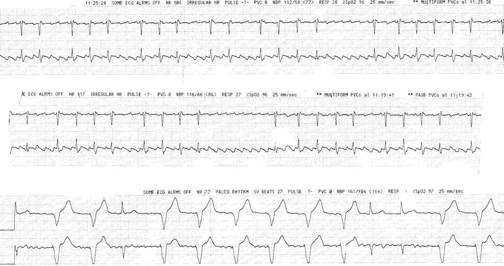 4/14/15 Topics for Today HTEC 91 Medical Office Diagnostic Tests Week 5 Ventricular Rhythms PVCs: Premature Ventricular Contractions VT: Ventricular Tachycardia VF: Ventricular Fibrillation Asystole