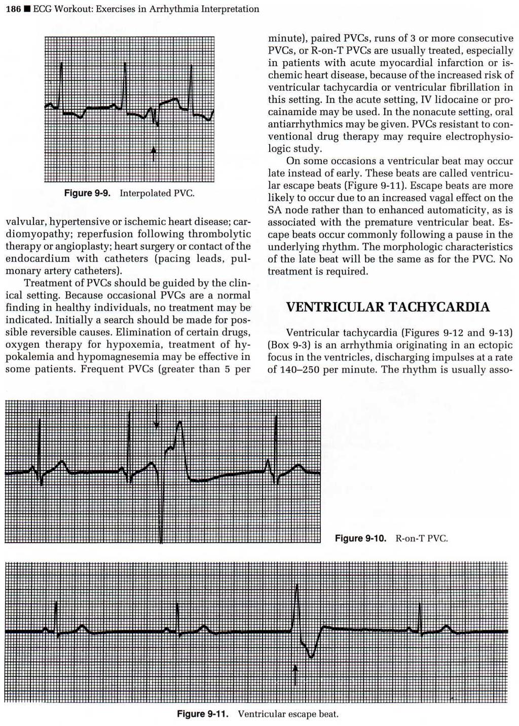 Ventricular Escape Ventricular Tachycardia (VT) Three or more PVCs in a row. Indicates myocardial irritability.