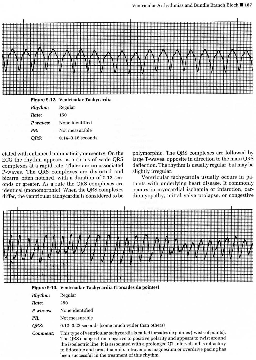 12 Lead ECG showing VT VT: 8 Steps 1. P wave: usually absent or not visible; retrograde p waves may be present. 2. Atrial rhythm: cannot be determined.