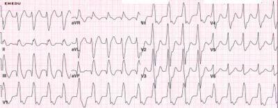 Ventricular rhythm: usually regular 6. Ventricular rate: usually rapid (100 to 250 beats / minute) 7. QRS complex: wide (>0.