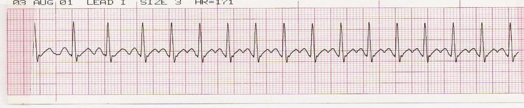 QRS complex can be present or absent 3. If QRS complex is present, PR interval is 0.12-0.2 or greater 4.