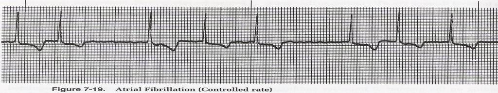 ATRIAL FLUTTER 1. Atrial rate: 250-400/minute 2.