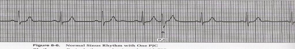 0.12 seconds (b) after the QRS complex (c) in the QRS complex