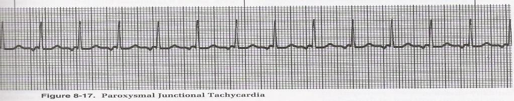 JUNCTIONAL RHYTHM 1. Ventricular rate: 40-60/minute 2.