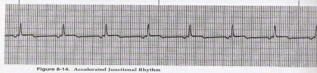 12 seconds (b) after the QRS complex (c) in the QRS complex (not seen) 3.