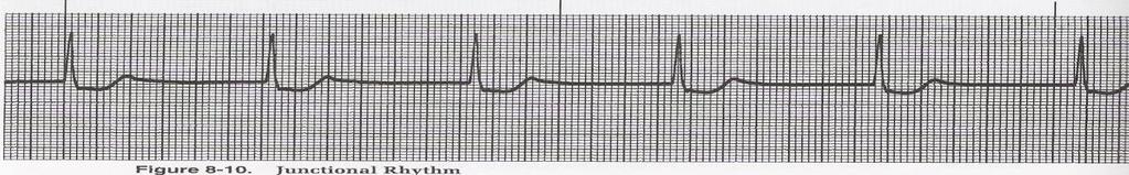 Ventricular rate: 60-100/minute 2. The P wave. (see above) 3. R-R interval: regular 4.