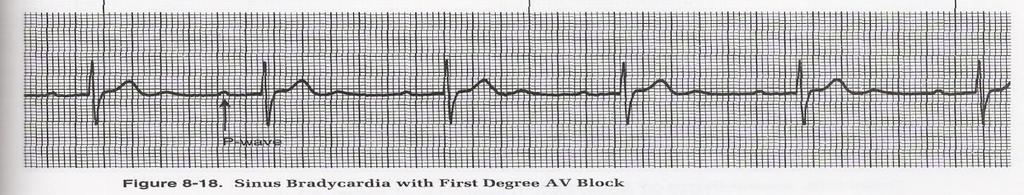 20 seconds and usually constant 2. P-P interval: regular 3. R-R interval: regular 4. QRS is usually less than 0.10 seconds SECOND DEGREE BLOCK - MOBITZ TYPE I (WENCKEBACH) 1.