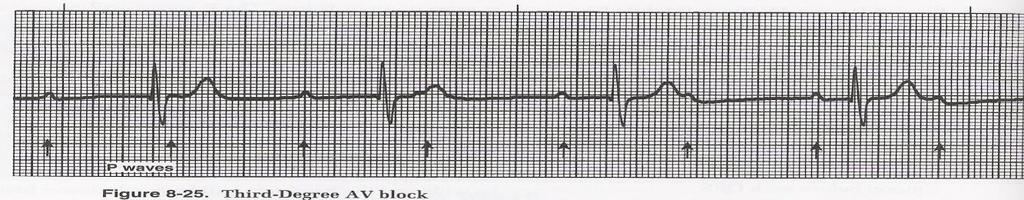 SECOND DEGREE BLOCK - MOBITZ TYPE II 1. Atrial rate higher than ventricular rate 2. P-P interval: regular 3.