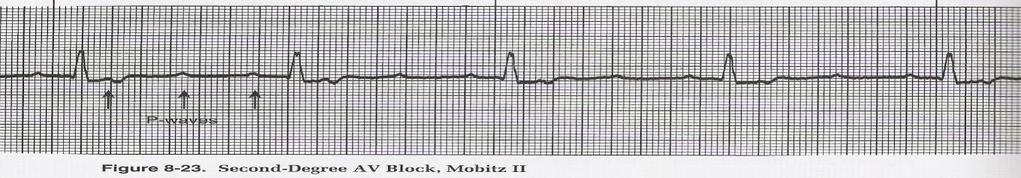 QRS is usually greater than 0.10 seconds THIRD DEGREE BLOCK (COMPLETE HEART BLOCK) 1. P-P interval: regular 2.