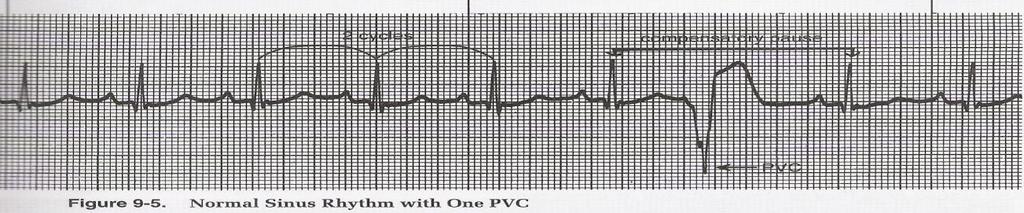 QRS complexes: wide and bizarre, greater than 0.12 seconds 3. No associated P waves 4.