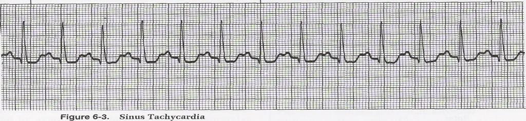 QRS is 0.1 or less SINUS TACHYCARDIA 1. Atrial & Ventricular rate 100-150/minute 2.