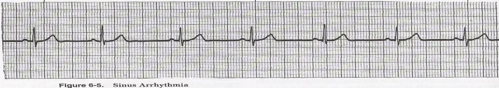 12 seconds or greater 3. PR interval: 0.12-0.2 seconds 4. QRS is 0.