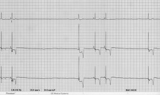 3) P and QRS relationship Find what you think are P waves Find what you think