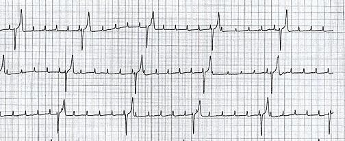 3) P and QRS relationship 4) P wave