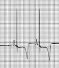 5) QRS complex morphology Causes of