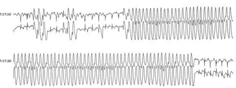 Could the arrhythmia result in clinical