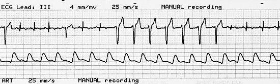 patients Ventricular rhythm with heart rate of 100-160 Typically