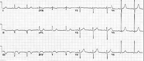Non-ST Elevation Infarction Here s an ECG of an inferior MI later in time: Now