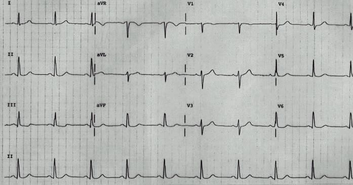 Left Ventricular Hypertrophy Compare these two 12-lead ECGs.