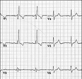 Bundle Branch Blocks With Bundle Branch Blocks you will see two changes on the ECG. 1. QRS complex widens (> 0.