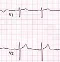 For LBBB the wide QRS complex assumes a characteristic change