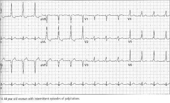 Wolff-Parkinson-White Syndrome Short PR interval <0.12 sec Prolonged QRS >0.