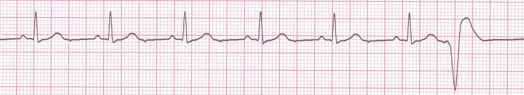 PVCs Deviation from NSR Ectopic beats originate in the ventricles resulting in wide and bizarre QRS complexes.