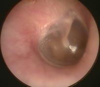 EAR) TYMPANOMETRY / ACOUSTIC REFLEXES Middle Ear Function: Transfer of