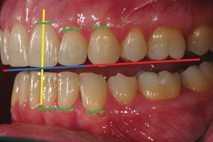 Postoperative oblique smile photo showing the correct angulation of the proclined maxillary incisor to improve horizontal and vertical