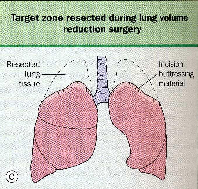Surgical Treatment Lung volume reduction surgery Bullectomy Lung transplantation we do it only if the pt have alpha one antitrypsin deficiency.