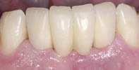 Bridges: Although it is best to copy natural dentitions and have one implant per tooth, in certain situations it may be practical to utilize a fixed-bridge prosthesis.